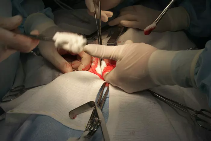 היילוד חולץ בחיים מבטנה של האם המורדמת מספר דקות לאחר תחילת הניתוח