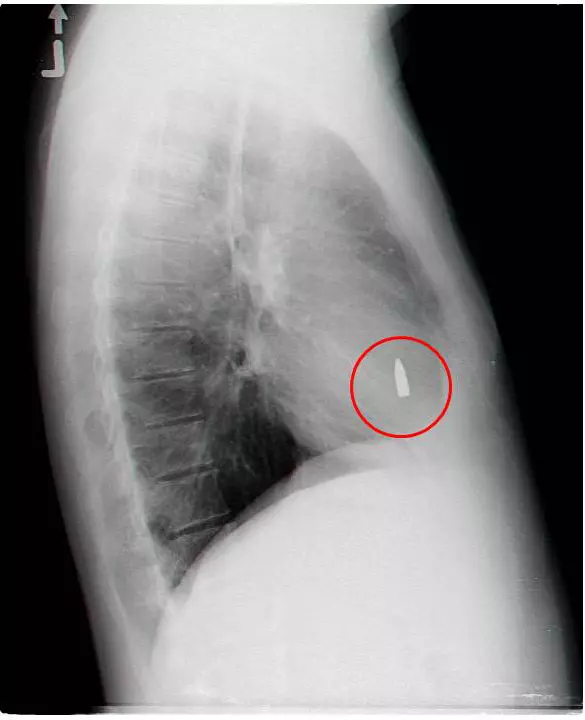 "במידה והקליע היה חודר עמוק יותר היה מדובר על נזק קטלני". צילום הרנטגן שנערך לפינסקי ובו נראה הקליע