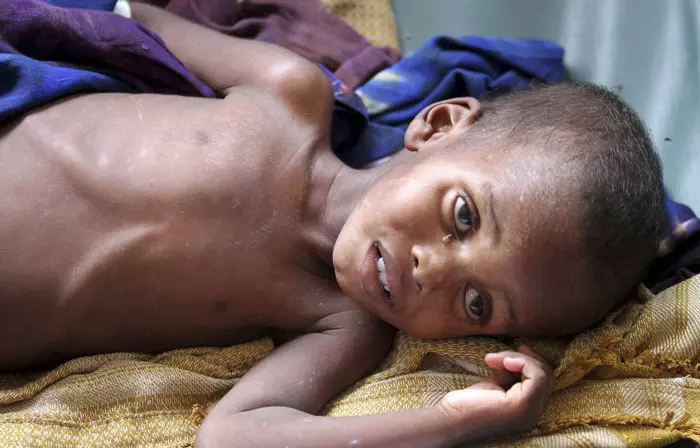 "כל יום שהסיוע מתעכב - עניין של חיים ומוות". ילד הסובל מתת תזונה, אתמול בבית חולים בבירה מוגדישו