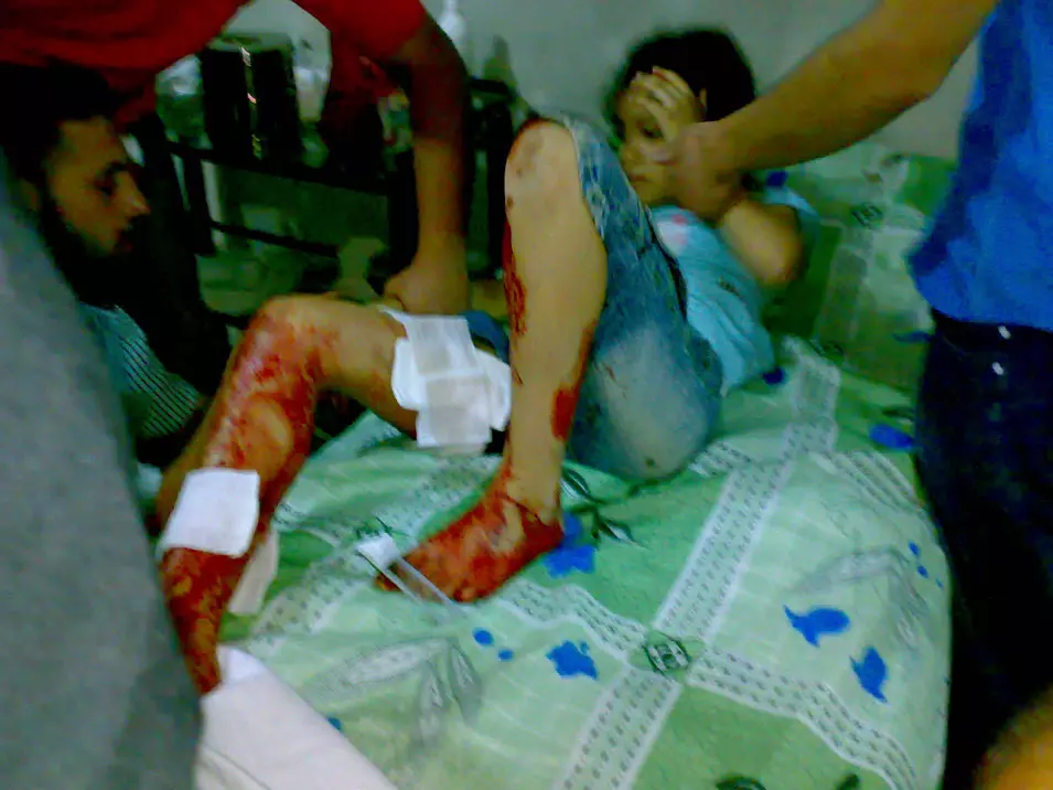 נערה שנפצעה בהפגזות צבא סוריה מטופלת בבית חולים מאולתר בכפר מערת מרסין ליד העיר אידליב שבצפון המדינה, אתמול