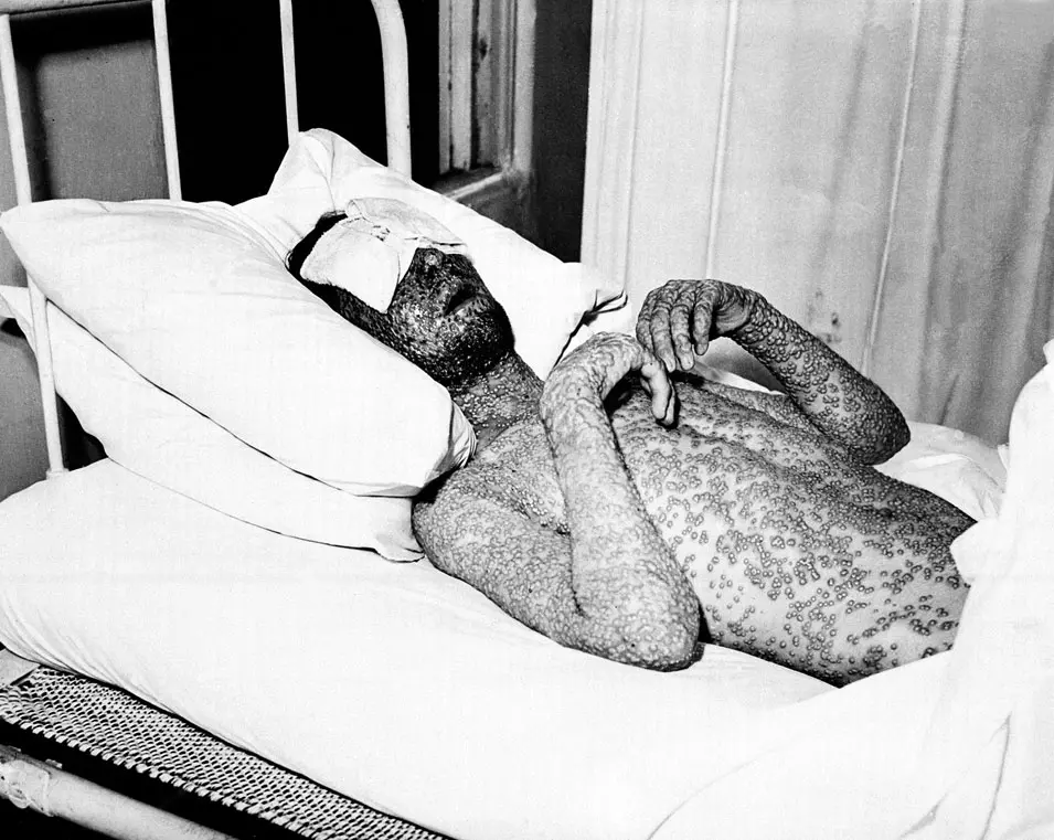 חולה אבעבועות שחורות בניו יורק, 1941