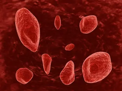 כדוריות דם. מחסור בברזל מאבחנים בבדיקות דם