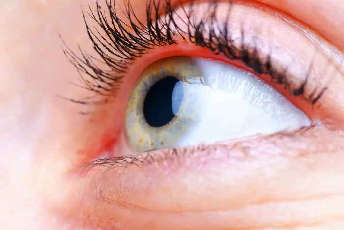 הניוון המקולרי הינו מחלת עיניים בה ניזוקים תאים עדינים במקולה