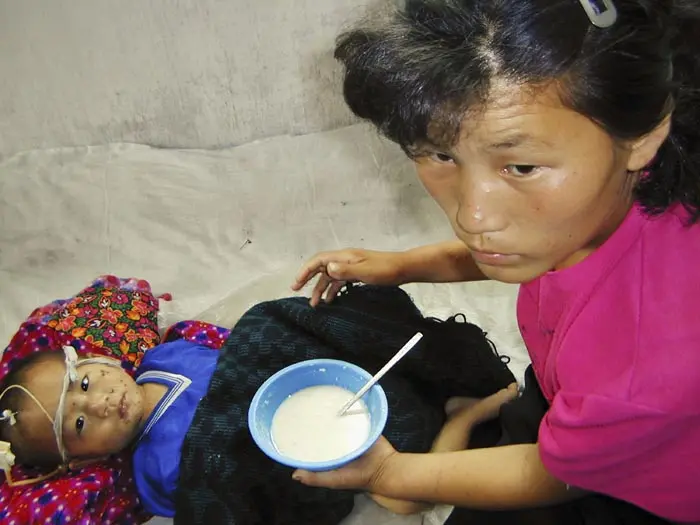 תינוק בקוריאה הצפנוית שסובל מתת-תזונה