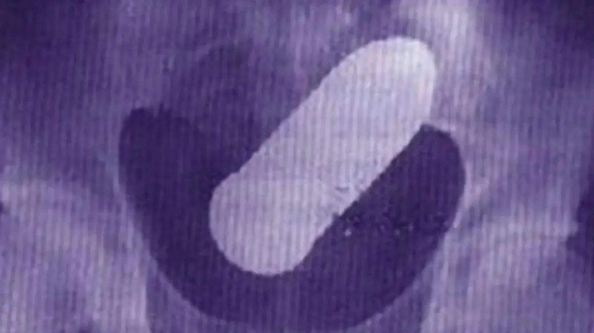 דרמה במיון: בית חולים פונה לאחר שצעיר הגיע עם פגז ממלחמת העולם הראשונה בישבנו