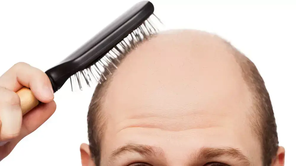התקרחות התקרחות
