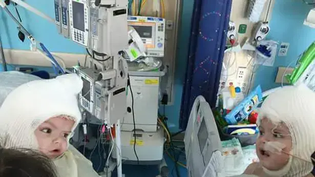 ג'ייסון ואניאס מקדונלד תאומים סיאמיים שהיו מחוברים בראש והופרדו רואים זה את זה בפעם הראשונה