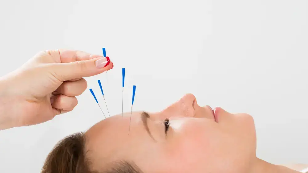 דיקור סיני קוסמטי