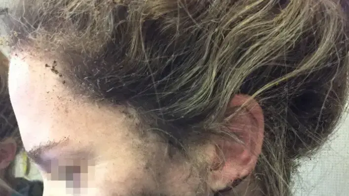 אישה שאוזניות התפוצצו עליה בטיסה