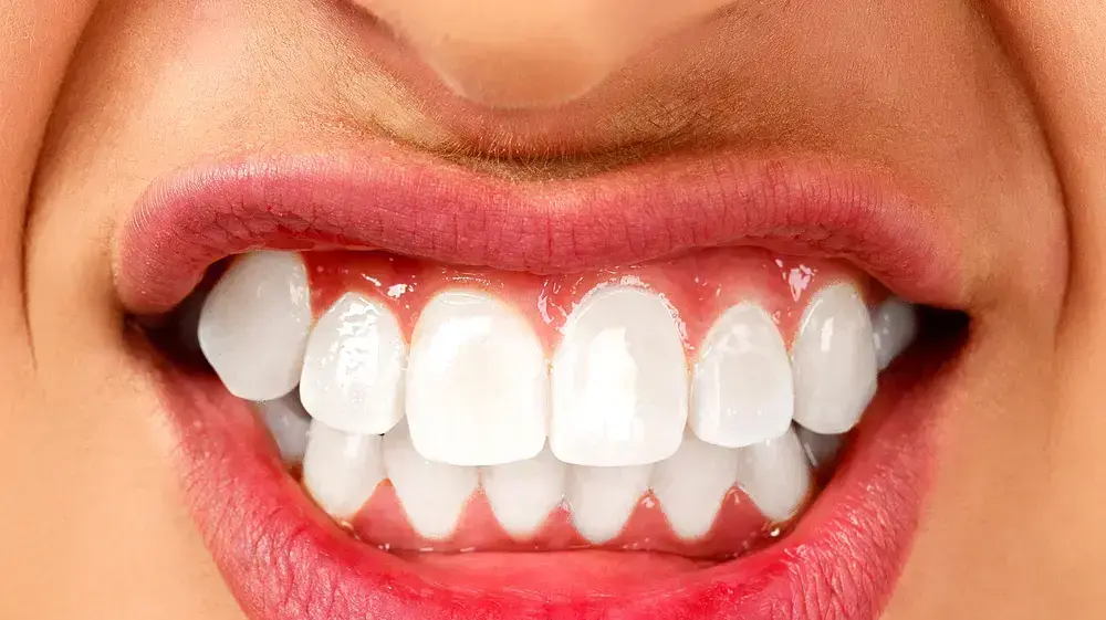 חריקת שיניים חריקת שיניים