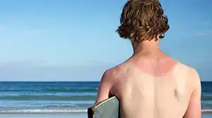 כוויית שמש