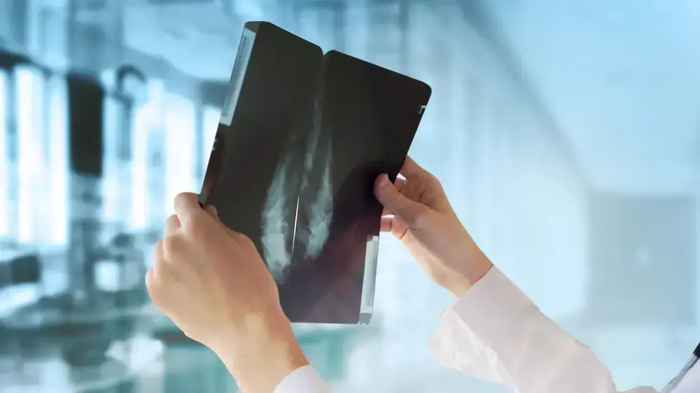 ממוגרפיה לסרטן השד
