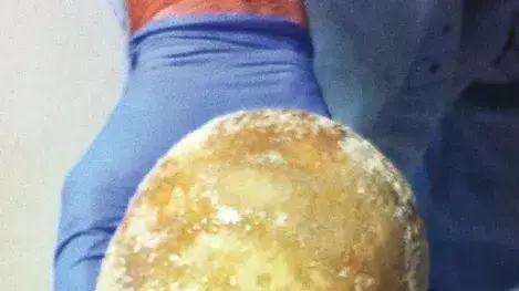 רופאים הסירו אבן בגודל של ביצת יען משלפוחית שתן של מטופל