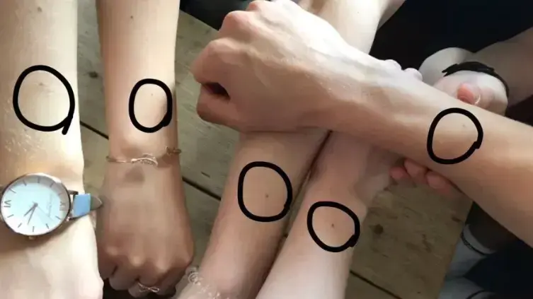 נשים עם נמש על גב היד