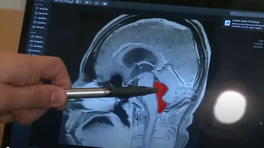 MRI מוח