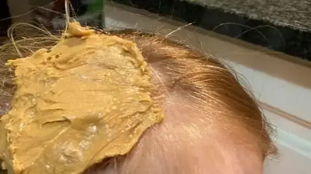 טיפ להסרת מסטיק שנדבק לשיער בעזרת חמאת בוטנים