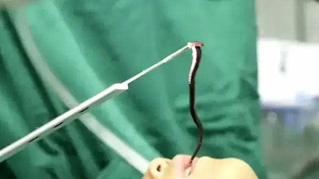 עלוקות מוצאות מגוף של מנותח