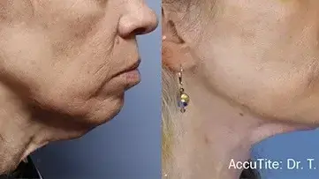 Accutite