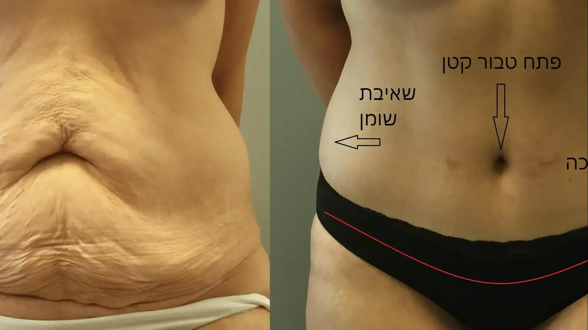 מתיחת בטן