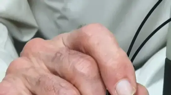 אבחון מלנומה במעבדה של פרופ' קציר
