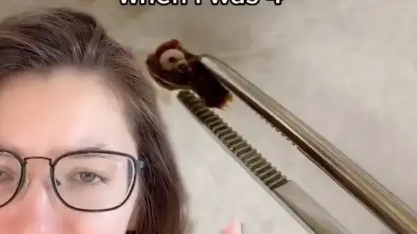 מה מצאו באוזן של הבחורה שסבלה מצינון?