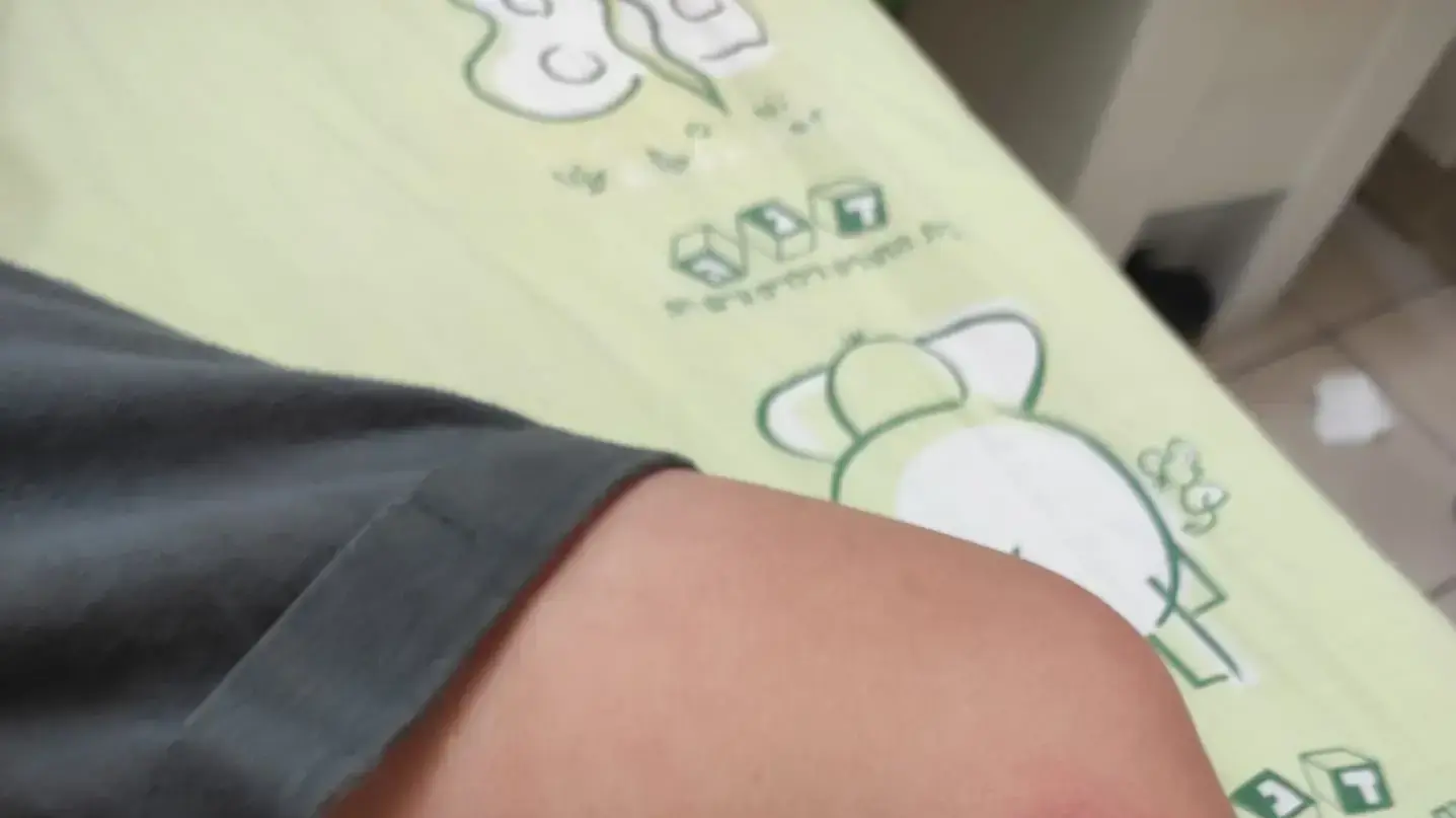 רגל  של ילד שנפגע מצריבת מדוזה