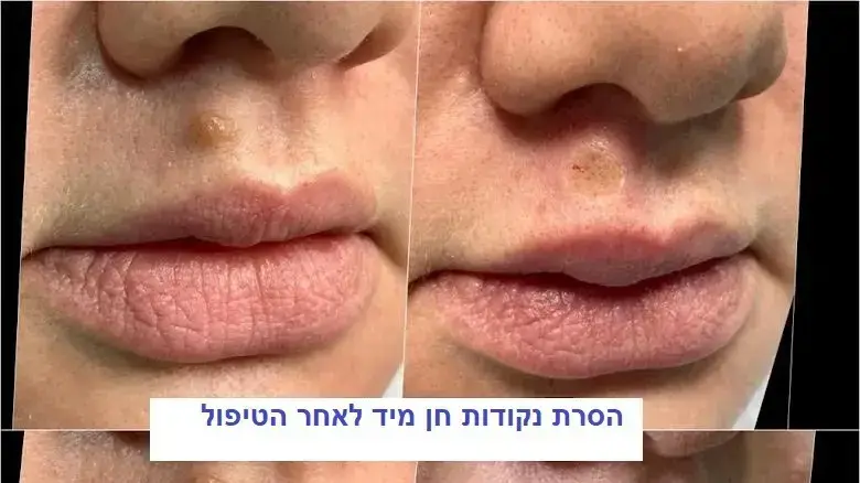הסרת נקודות חן תוצאות: מיד אחרי ולאחר חודש החלמה