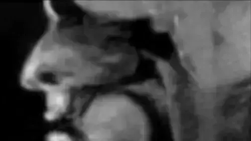 MRI לשון MRI לשון