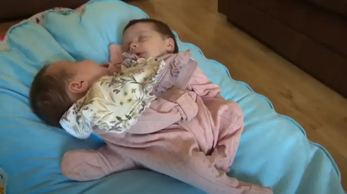 תאומות סיאמיות