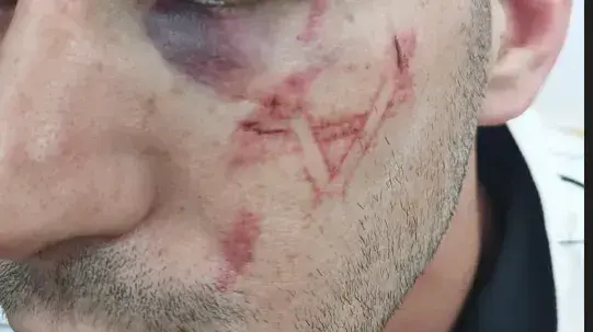 העצור הפלסטיני עם סימן של מגן דוד מתחת לעין
19.8.23