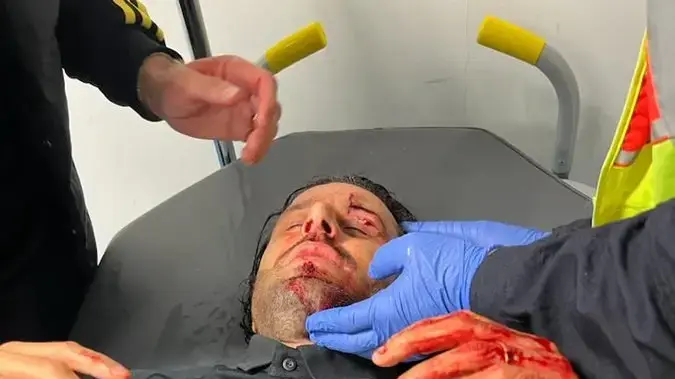 פאביו גרוסו מאמן ליון לאחר שנפצע מבלוקים שנזרקו על האוטובוס מצד אוהדי מארסיי