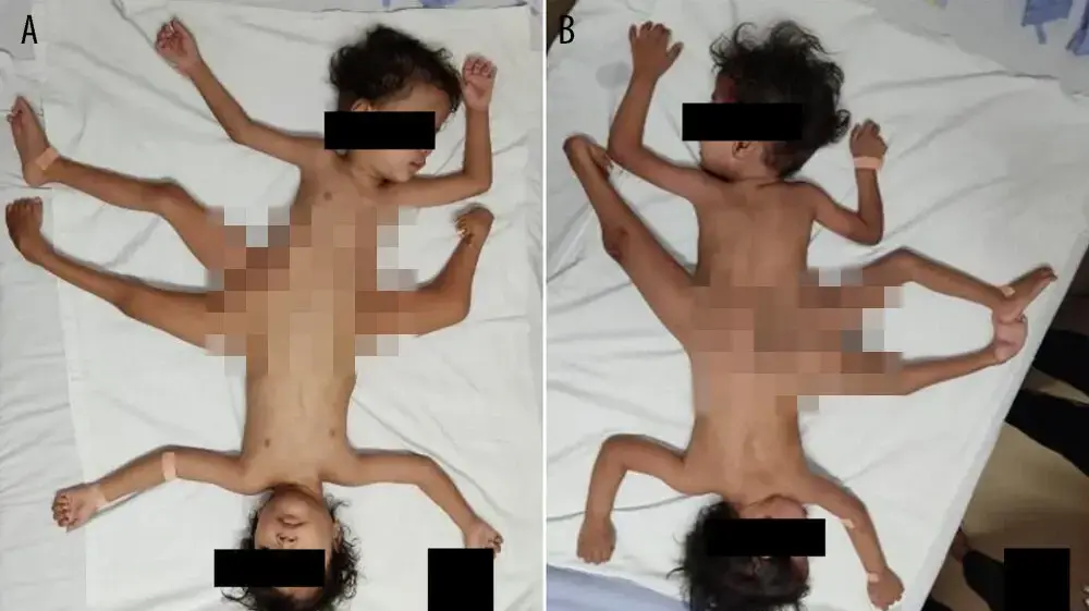 תאומים סיאמים עם שלוש רגליים, ארבע ידיים ואיבר מין אחד