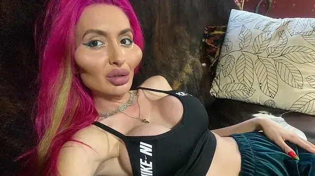 האישה עם הלחיים הגדולות בעולם