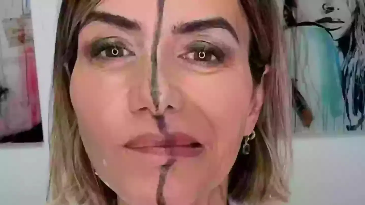 רופאה הזריקה בוטוקס לחצי מהפנים