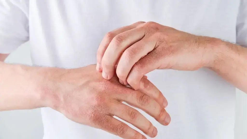 אטופיק דרמטיטיס