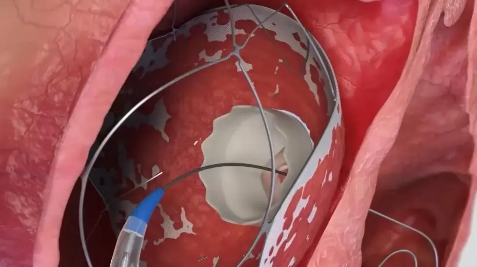 הדמיית השלב הסופי של השתלת מערכת העגינה RoseDoc באמצעות צנתור