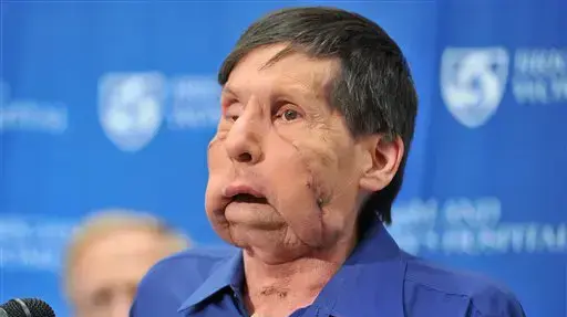 ג'יימס מקי מושתל הפנים השני