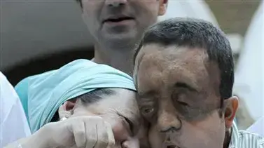 מושתל פנים מספרד נחשף לאחר הניתוח