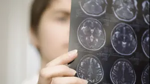 רופאה מביטה בצילום רנגטן של מוח
