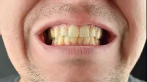 שיניים צהובות