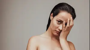 אישה צעירה עם אקנה