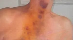 סימני מכות וחניקה על גופו של הקשיש