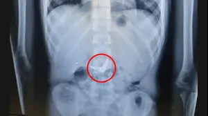 ילד בלע מספריים וטופל בביח שערי צדק