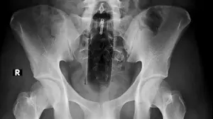 צילומי רנטגן של דברים שנמצאו בישבנים