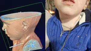השיפוד נתקע בגרונו של בן ה-5