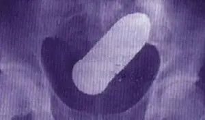 דרמה במיון: בית חולים פונה לאחר שצעיר הגיע עם פגז ממלחמת העולם הראשונה בישבנו